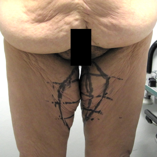 Medial Thigh Lift Before
